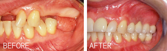 Sinus Lift And Bone Graft