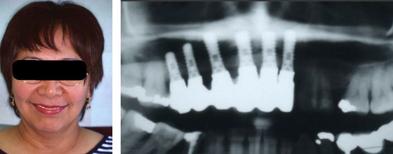 Oral Reconstruction